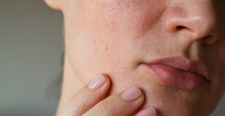 Pourquoi ta peau tiraille après la douche (et comment y remédier)